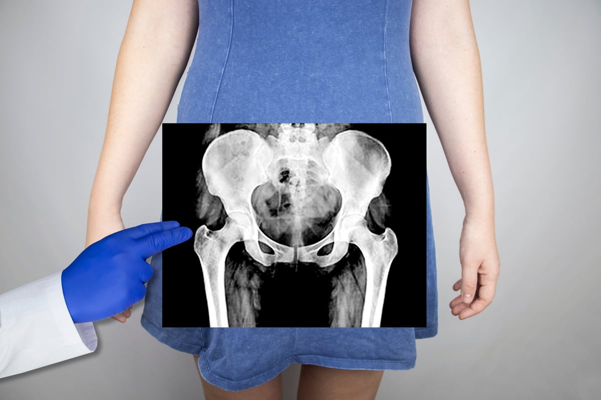 X-Ray of the Pelvic Bones of a Woman